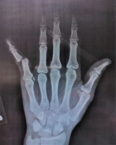 X-Ray - Dislocated Little Finger & Bone Chip