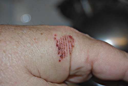 hand abrasion